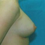 Breast Augmentation Before & After Patient #4993