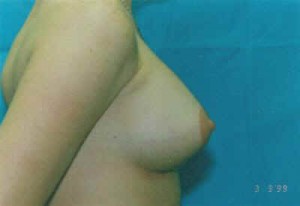 Breast Augmentation Before & After Patient #4993