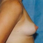Breast Augmentation Before & After Patient #4993