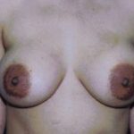 Breast Augmentation Before & After Patient #5000