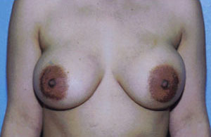 Breast Augmentation Before & After Patient #5000