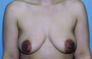 Breast Augmentation Before & After Patient #5000