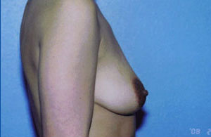 Breast Augmentation Before & After Patient #5000