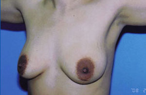 Breast Augmentation Before & After Patient #5000