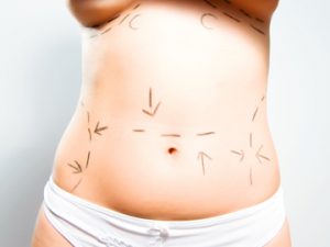 Mini vs Full Tummy Tuck