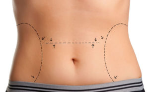 Tummy Tuck Corpus Christi